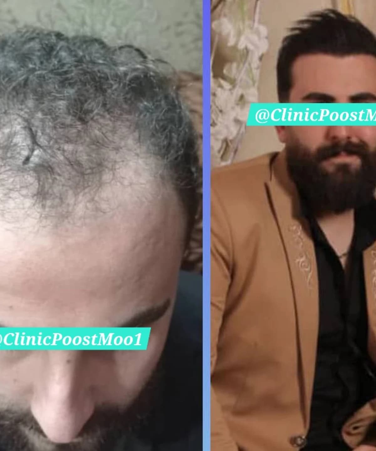 کاشت مو و ابرو بدون کوتای و جراحی